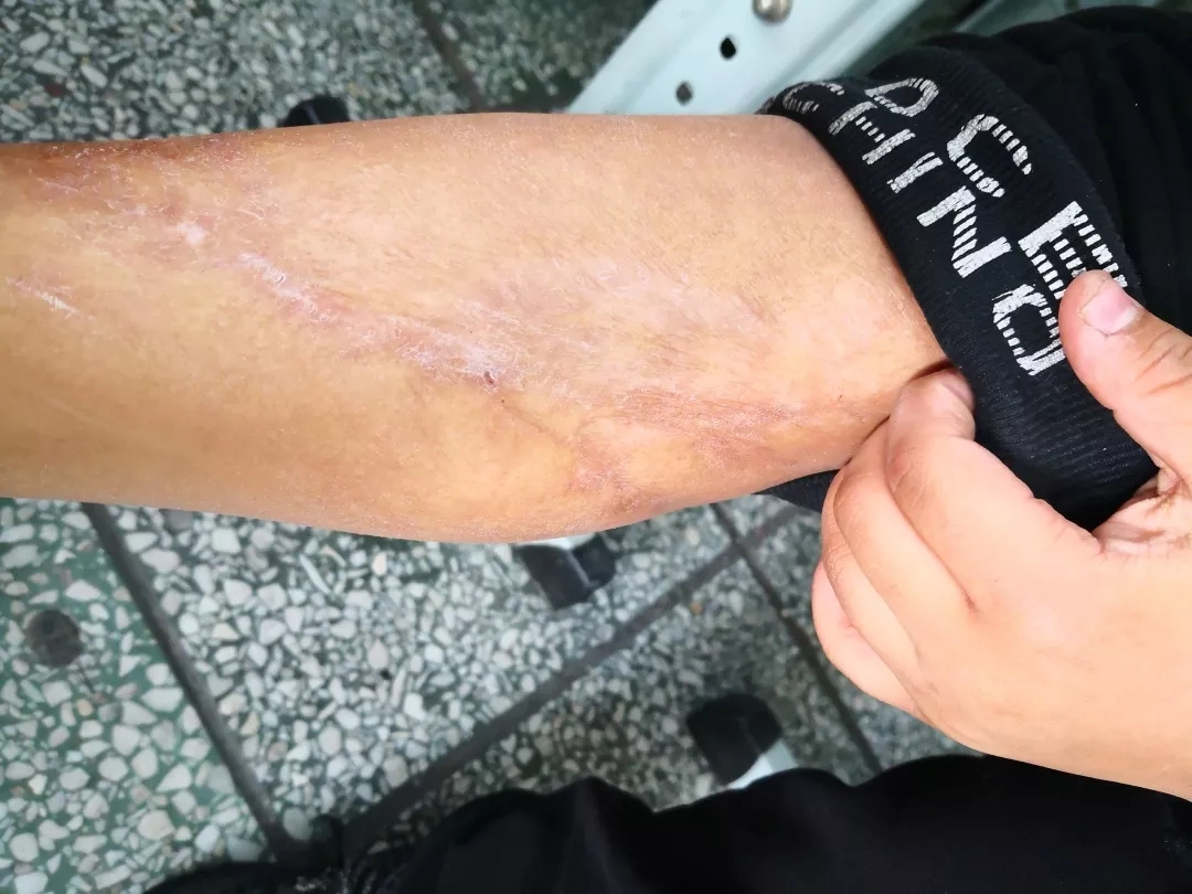 刘宝宝左手因热液烫伤导致的增生性疤痕治愈了_北京疤痕医院_瘢痕修复_疤痕治疗_北京疤康医院【官】